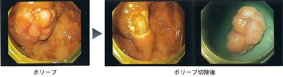 当院の大腸内視鏡検査